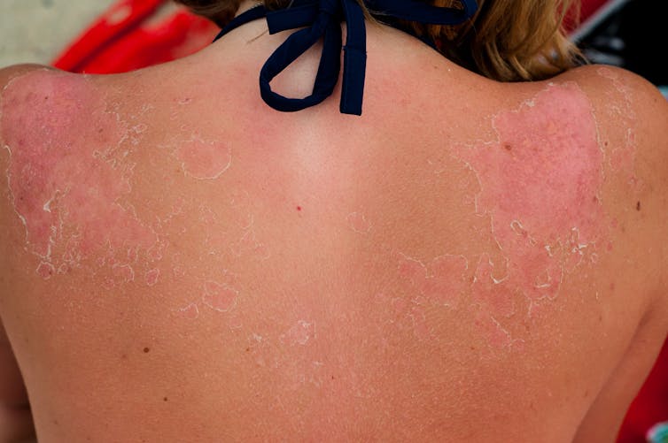 The red, peeling sunburnt back and shoulders of a young girl.